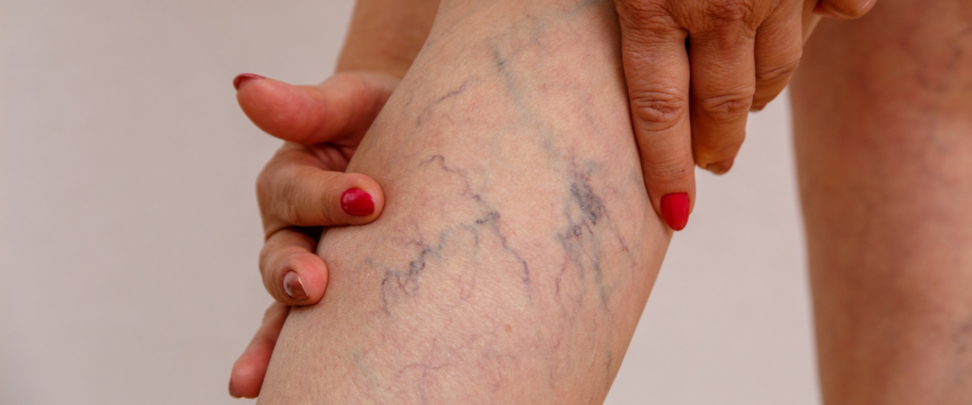 Natural Remedies for Treating Vein Diseases in St. Louis, Missouri