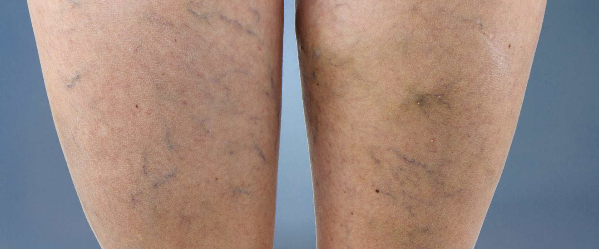 Finding the Right Doctor for Vein Disease Treatments in St. Louis, Missouri