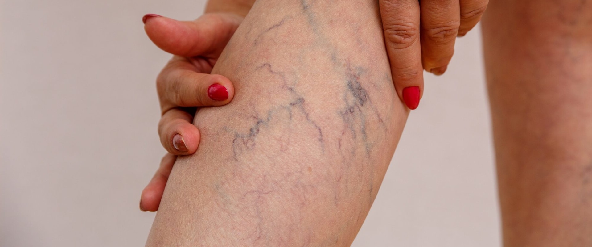 Treating Venous Insufficiency in St. Louis, Missouri: Dietary Changes to Consider