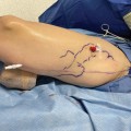 High Success Rate of Ambulatory Phlebectomy for Treating Vein Diseases in St. Louis, Missouri