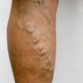 Success Rate of Laser Vein Treatment in St. Louis, Missouri