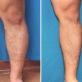 Insurance Coverage for Vein Disease Treatments in St. Louis, Missouri