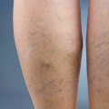 Treating Vein Diseases in St. Louis, Missouri: Supplements and Other Options