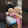 Success Rate of Foam Sclerotherapy for Treating Vein Diseases in St. Louis, Missouri