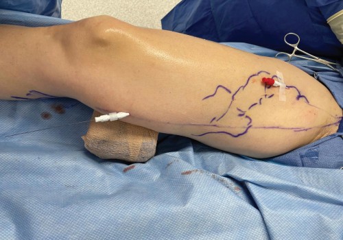 High Success Rate of Ambulatory Phlebectomy for Treating Vein Diseases in St. Louis, Missouri