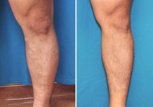 Recovery Time for Endovenous Laser Ablation Treatment for Treating Vein Diseases in St. Louis, Missouri