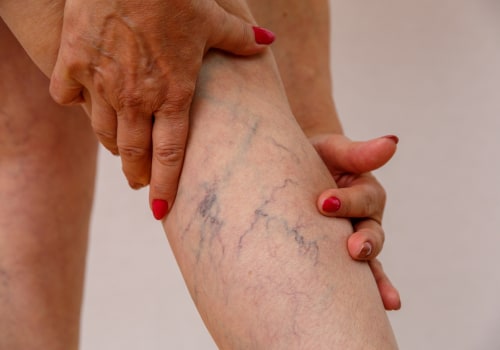 Natural Remedies for Treating Vein Diseases in St. Louis, Missouri