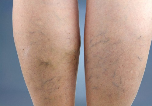 Treating Vein Diseases in St. Louis, Missouri: Supplements and Other Options