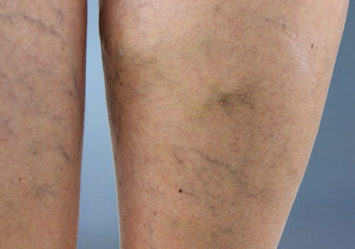 What is the Cost of Ambulatory Phlebectomy for Treating Vein Diseases in St. Louis, Missouri?