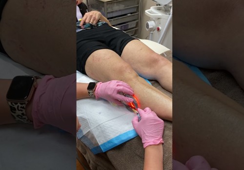 Success Rate of Foam Sclerotherapy for Treating Vein Diseases in St. Louis, Missouri